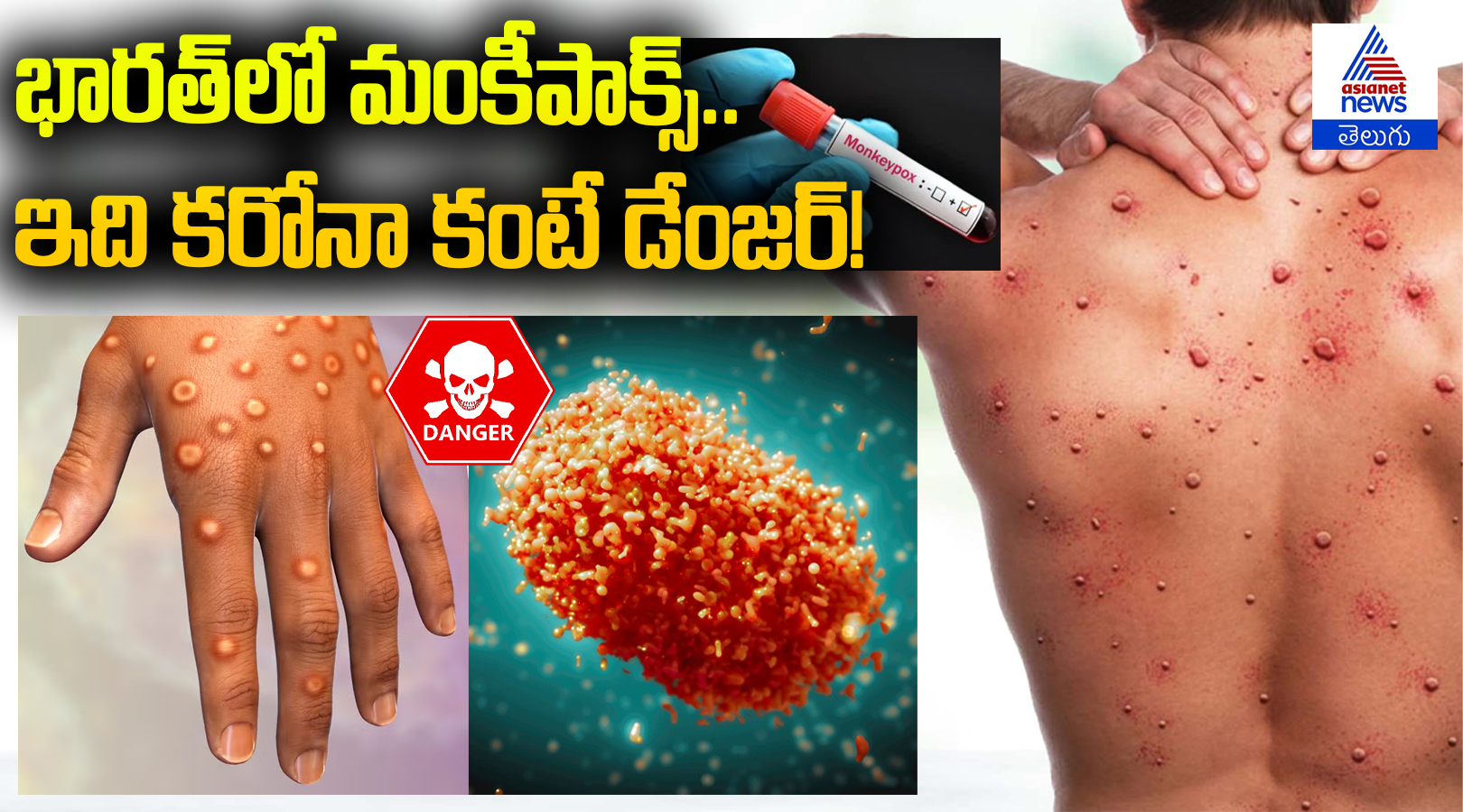 భారత్‌లో మంకీపాక్స్.. ఇది కరోనా కంటే డేంజర్!