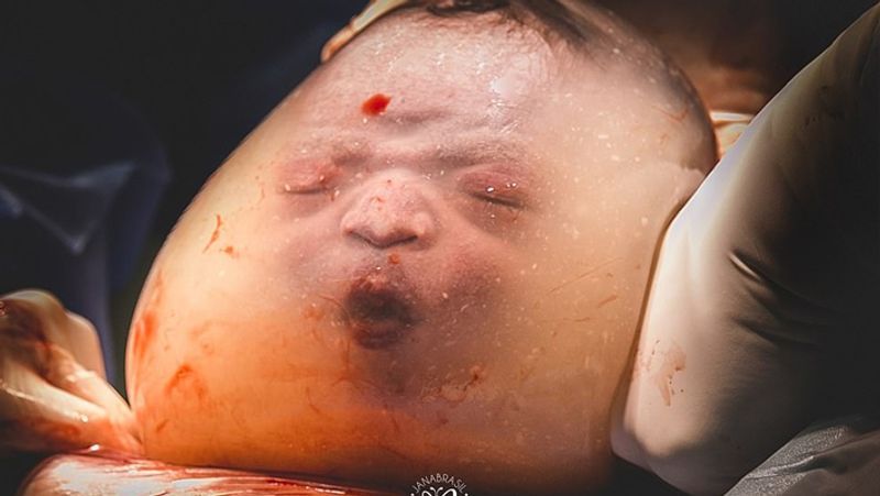 इस तस्वीर को मेंबर्स चॉइस बेस्ट इन बर्थ में सेलेक्ट किया गया। मां के गर्भ से इस तरह निकले बच्चे की तस्वीर ने काफी चर्चा बटोरी थी।
