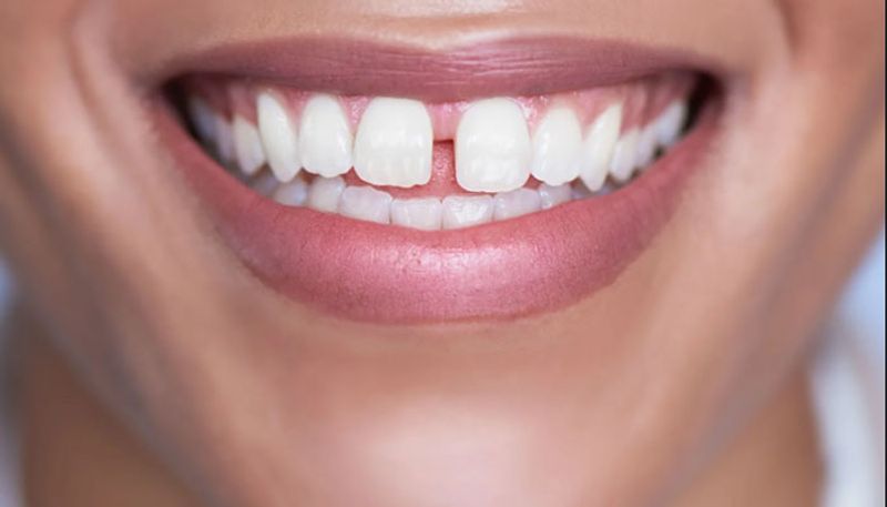 जिस व्यक्ति के दांतों में होता है गैप...वो होता है भाग्यशाली, जानें क्या  कहते हैं आपके दांत | know how your teeth define your character KPZ
