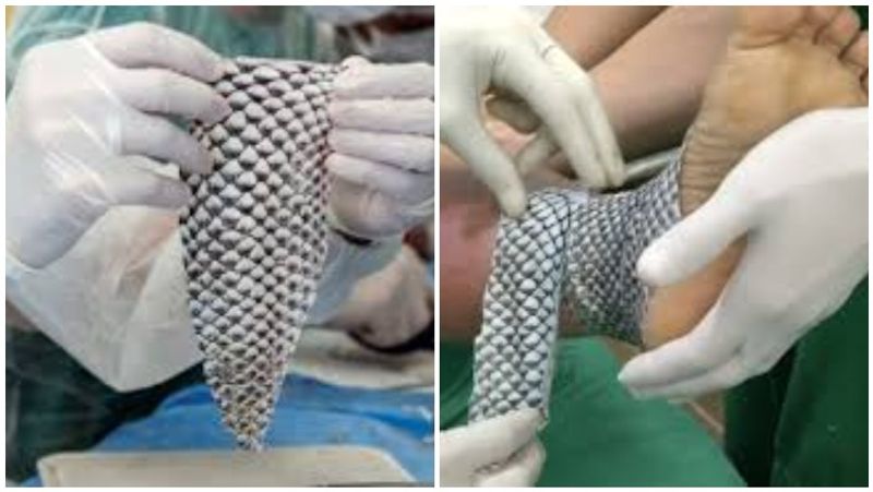 மீன் தோல் வைத்து தீ காயத்திற்கு சிகிச்சை! வியக்க வைக்கும் மருத்துவ முறை