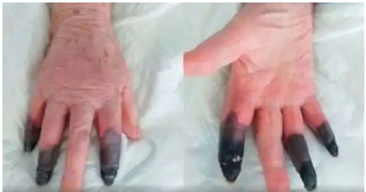 Black fingers on 86-year-old Kovid infected;  Doctors cut and replaced