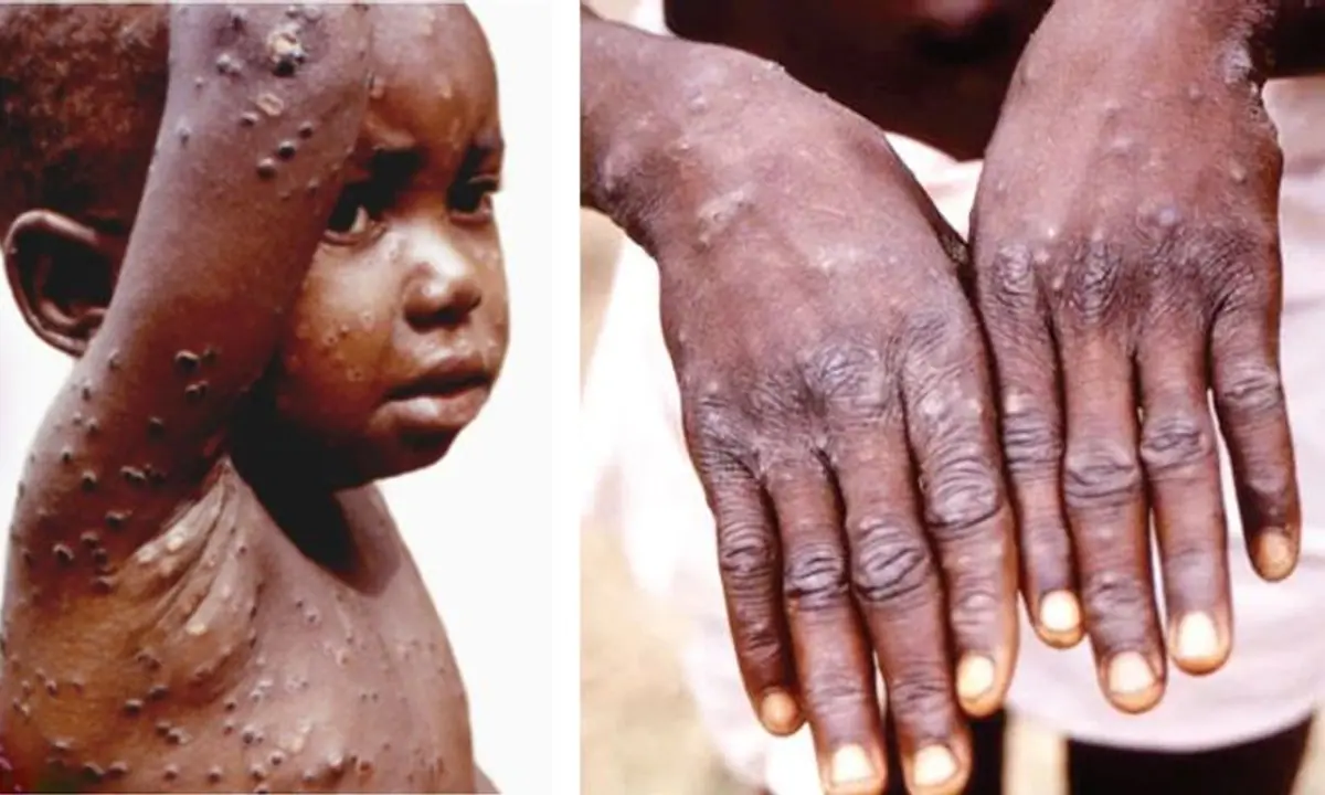  Monkeypox Virus: फिर बढ़ा एमपॉक्स वायरस का खतरा, तेजी से पसार रहा पैर,जानें लक्षण 