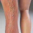 Why Do Varicose Veins Appear? Simple Fixes Before They Become a Problem