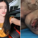 लड़की के दांतों में हुआ दर्द तो पड़ोस से ले आई 1 रु का पेनकिलर, खाते ही शरीर से अलग होने लगी चमड़ी