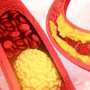 Health Tips for Lowering Bad Cholesterol Naturally and Effectively