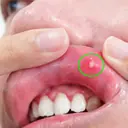Mouth Ulcer Relief: 8 Effective and Natural Home Remedies