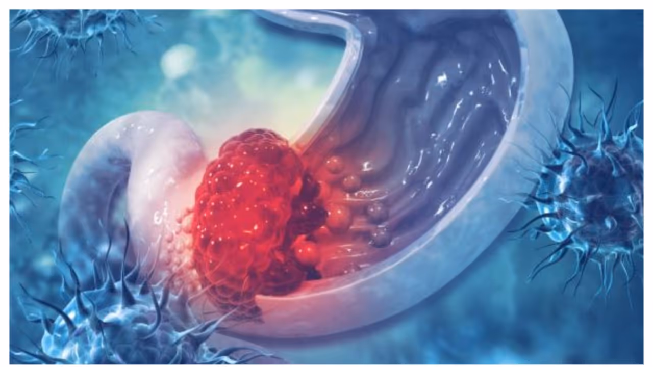 stomach cancer stomach cancer