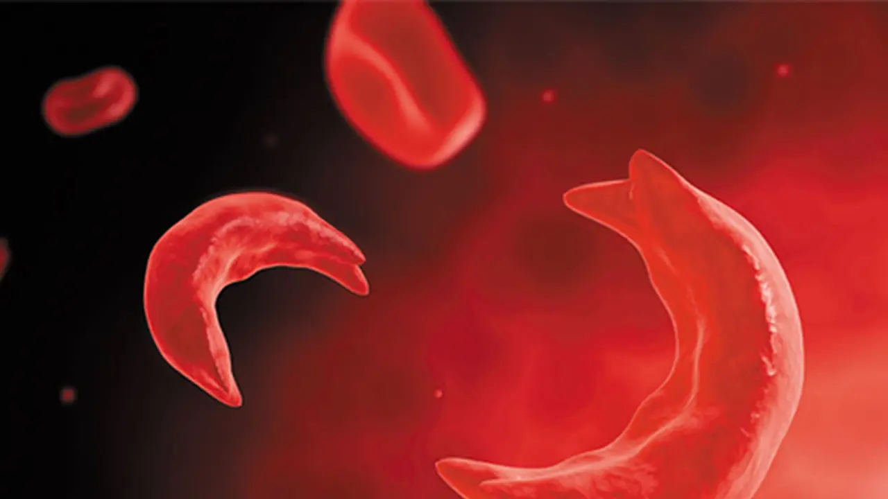 sickle cell anemia