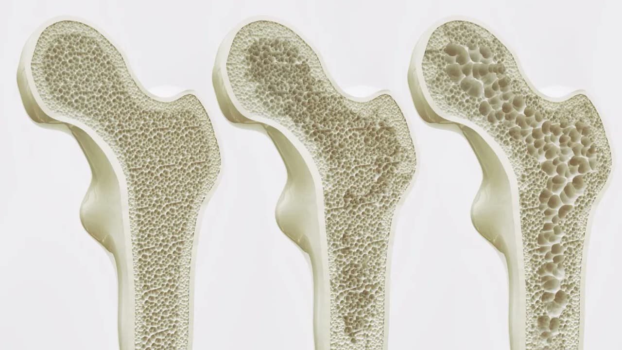 Scientists Reverse Osteoporosis in Mice with AP503