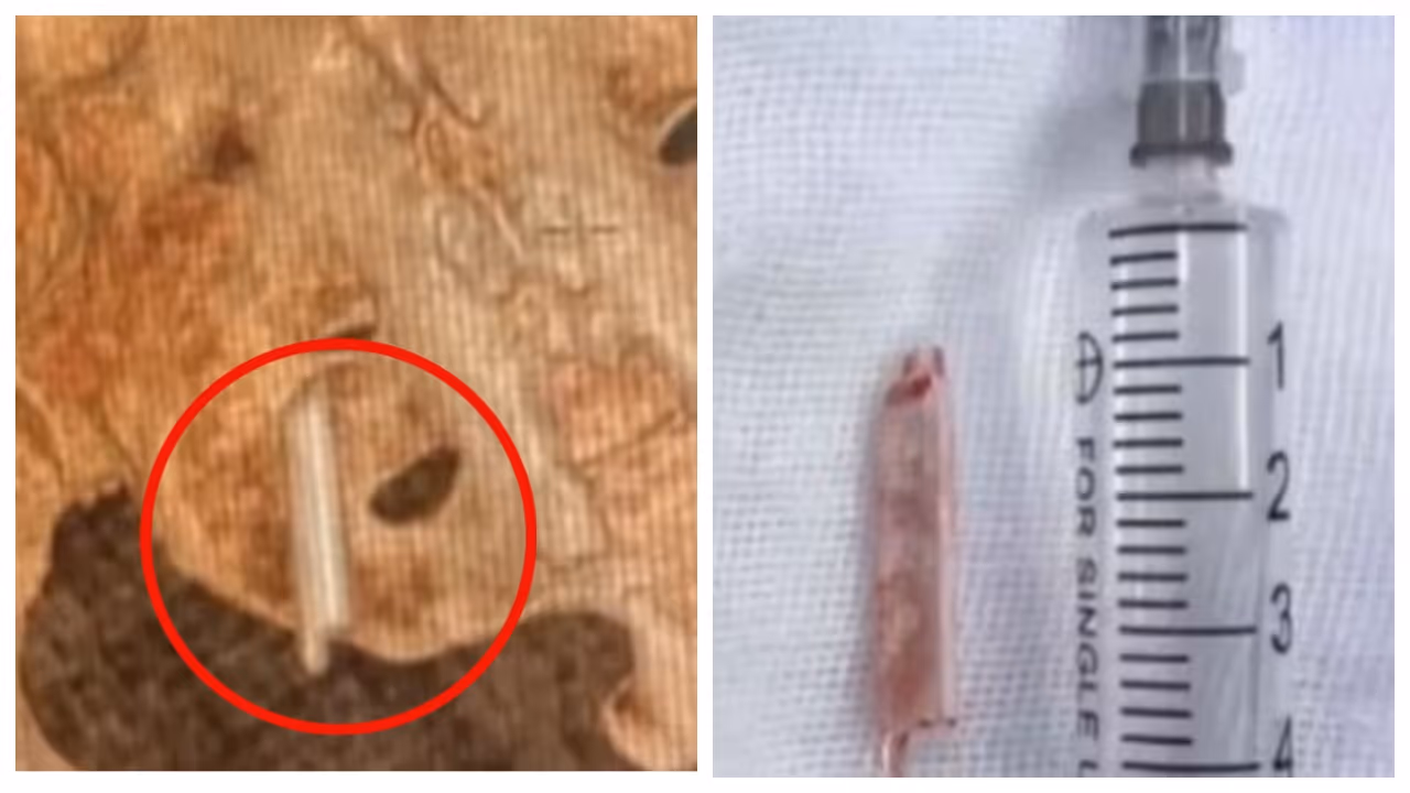 22 year old thermometer was removed from womans pelvis