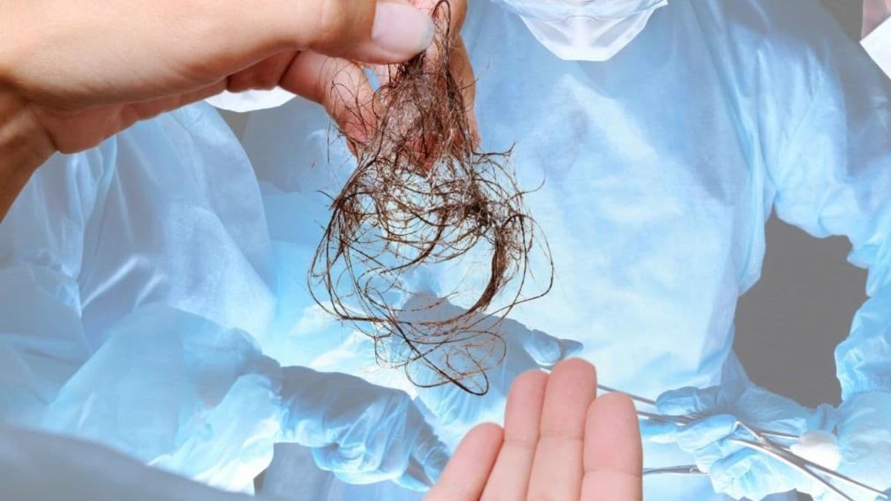 Ahmedabad doctors remove hairball