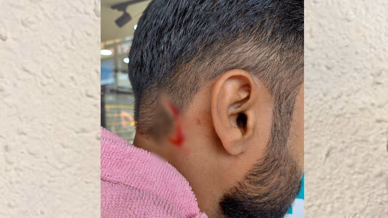 Man injured after stone from road flown and hit his head just after bus passed