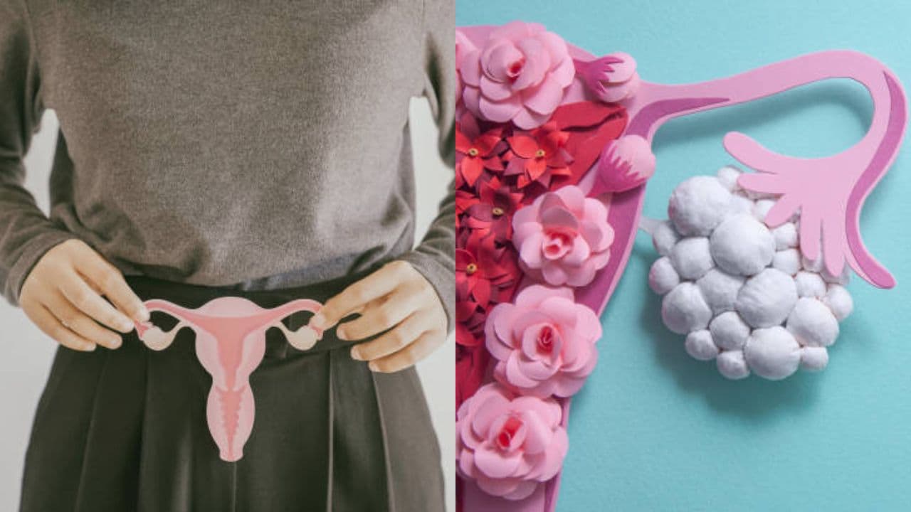 PCOS today vs past difference