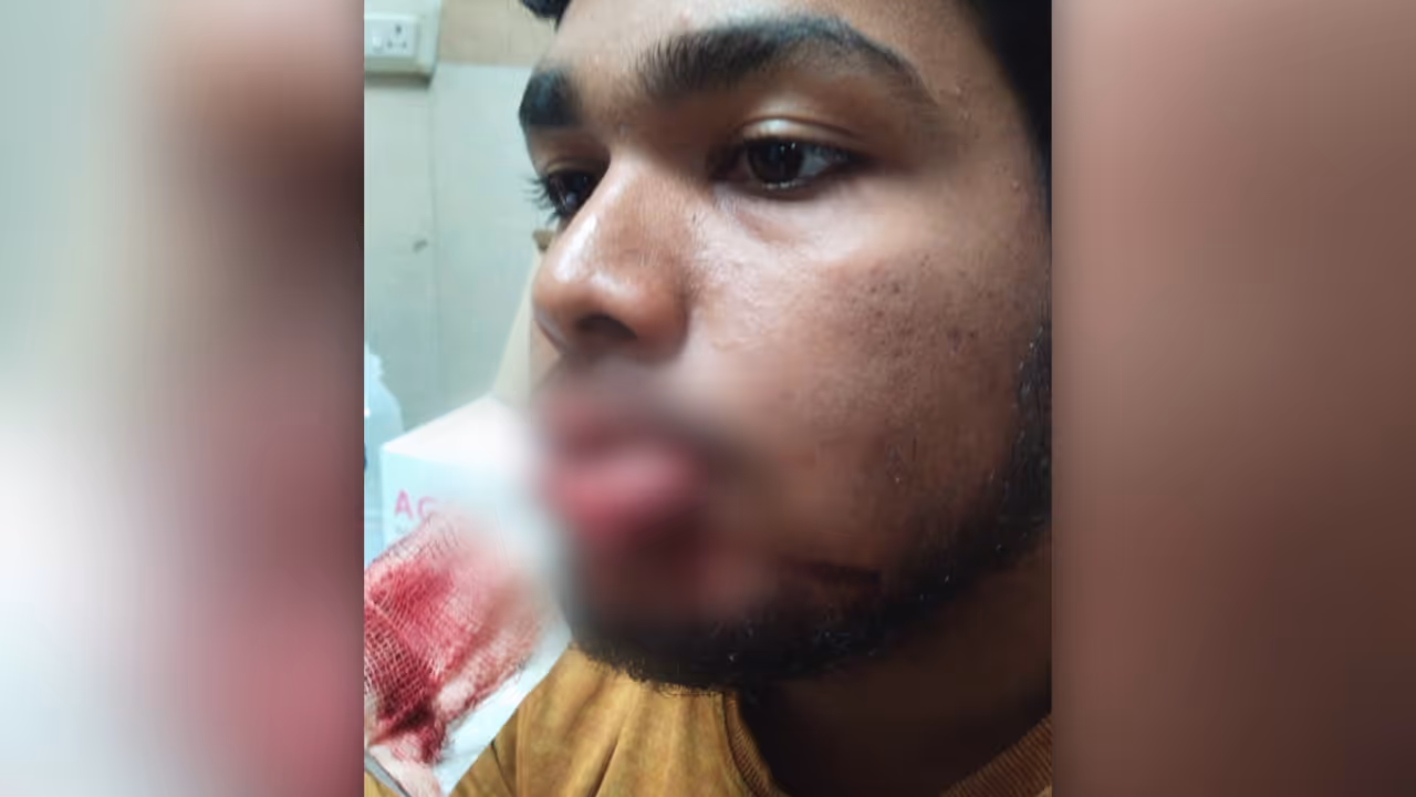 student face injury student face injury