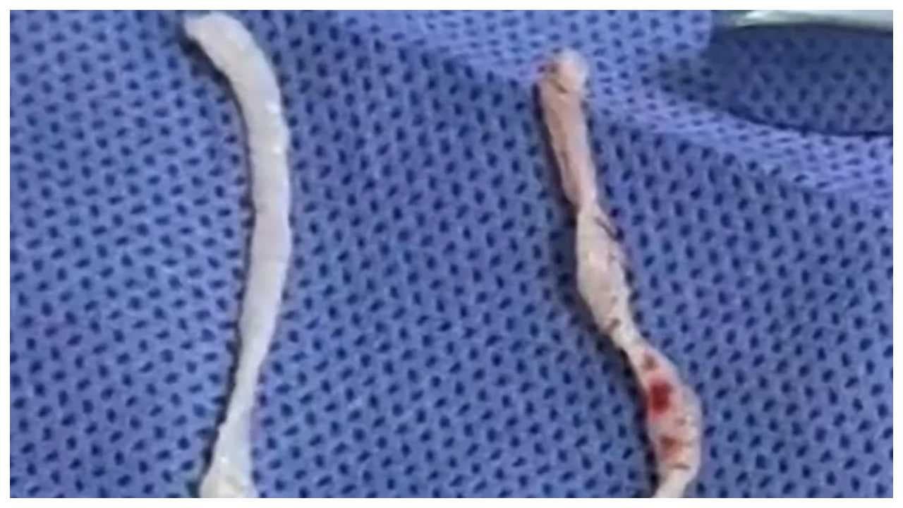 worms worms