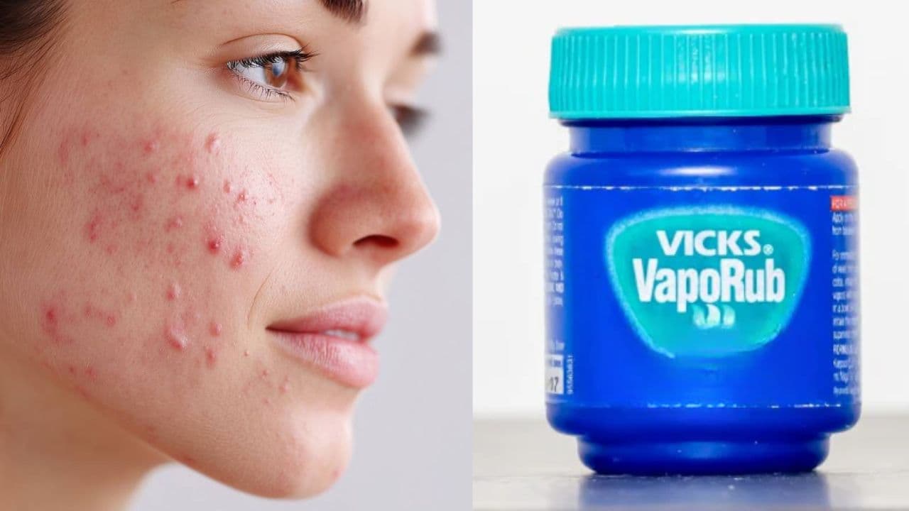 Vicks Used for Pimples Vicks Used for Pimples