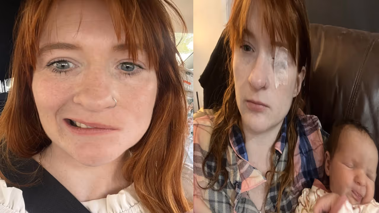 Bell's Palsy
