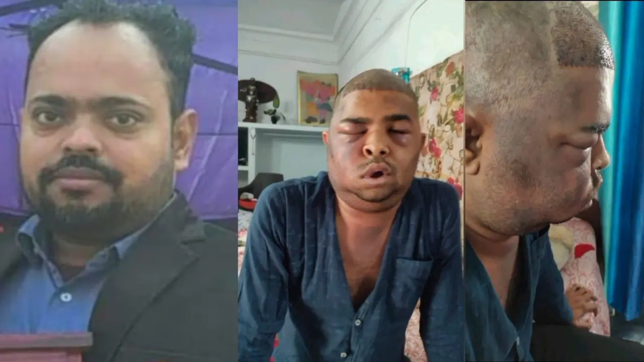 Kanpur hair transplant death