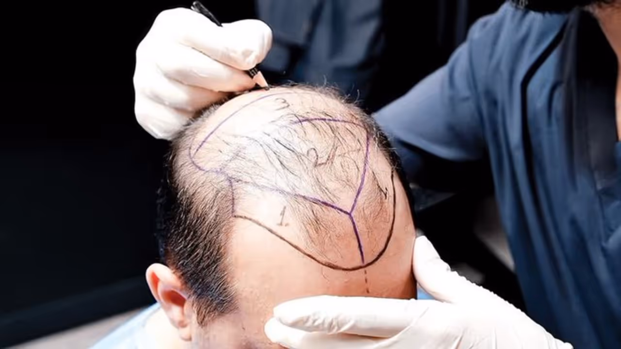 lashkar terrorist shabbir ahmed lone gurugram hair transplant dental treatment arrest delhi police lashkar terrorist shabbir ahmed lone gurugram hair transplant dental treatment arrest delhi police