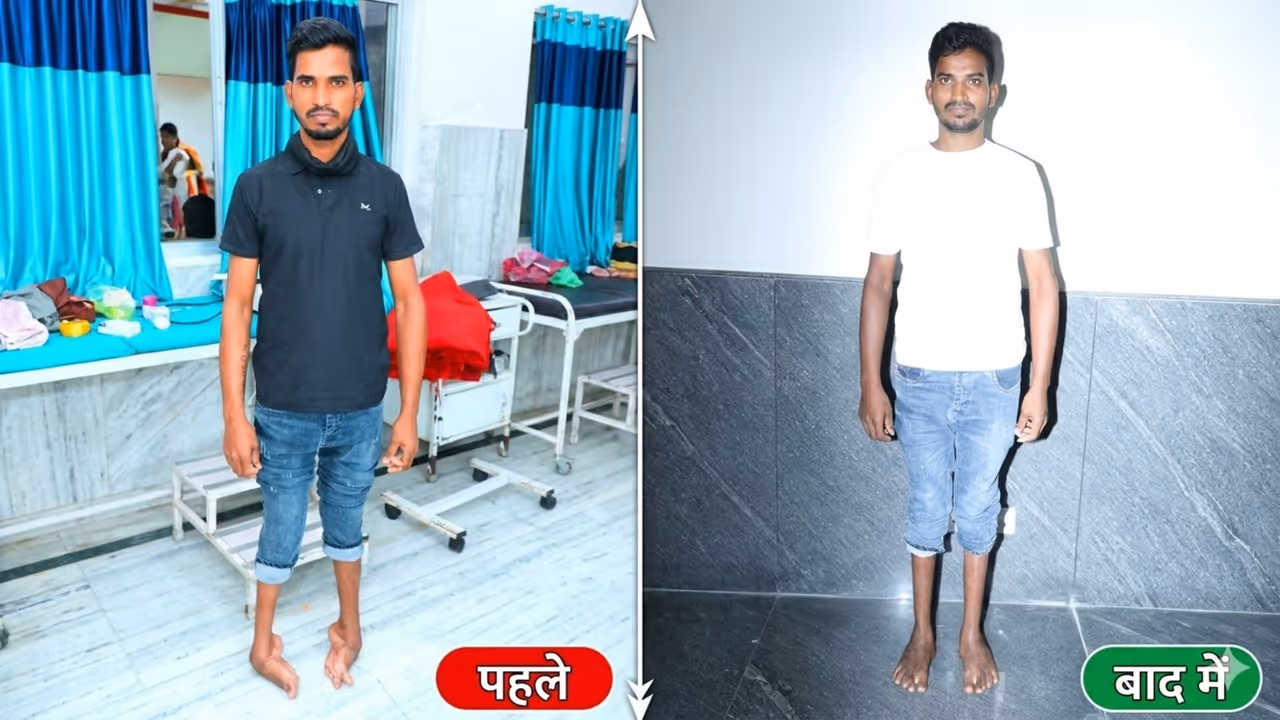 parsan kumar kushinagar clubfoot treatment narayan seva sansthan success story parsan kumar kushinagar clubfoot treatment narayan seva sansthan success story