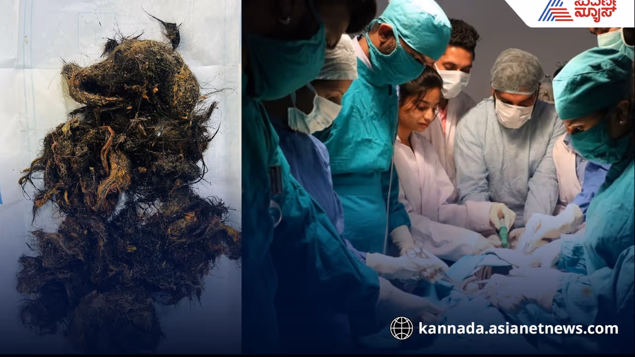 Bengaluru 8yrs girl has trichobezoar doctors perform surgery to remove hair