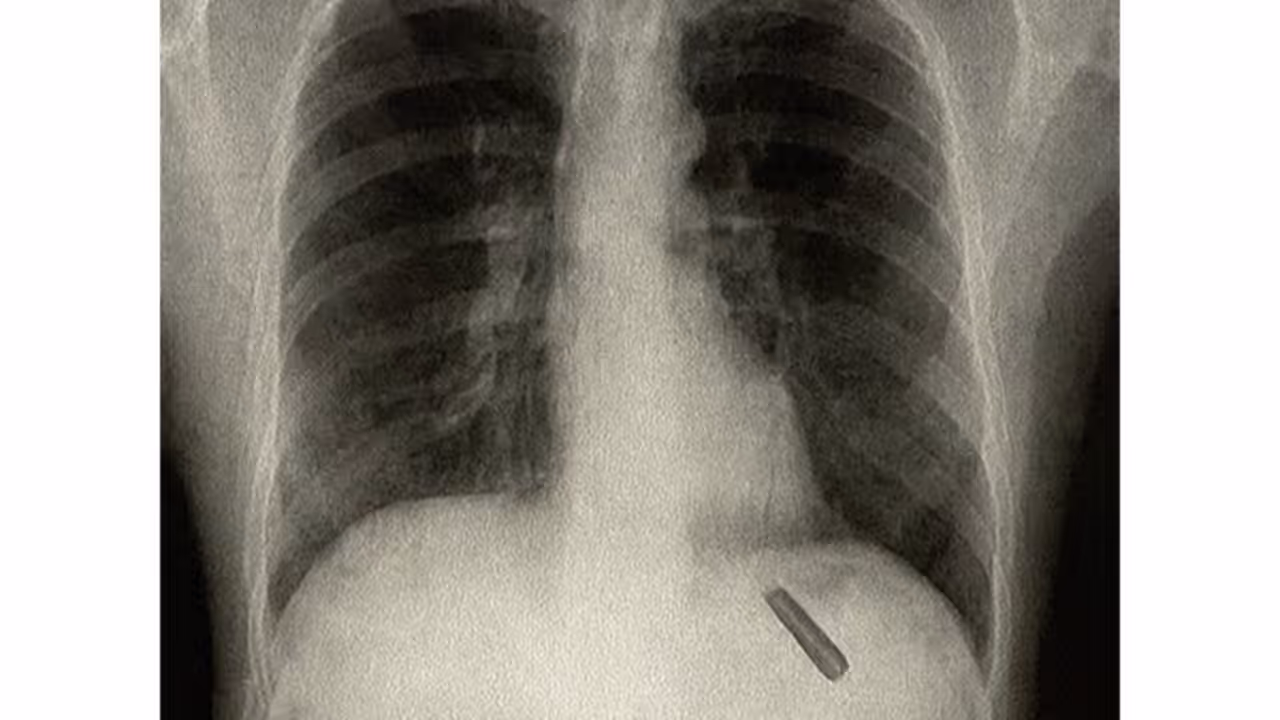 Pen cap stuck in lung