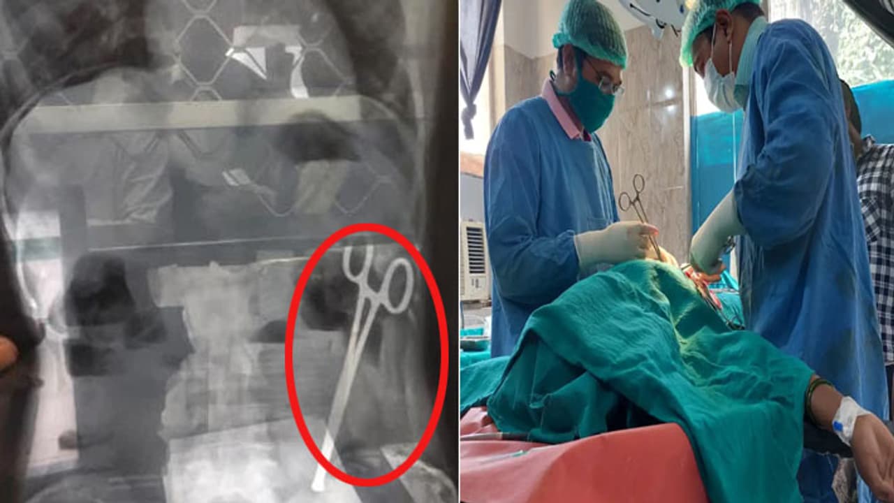 scissors left in stomach during operation