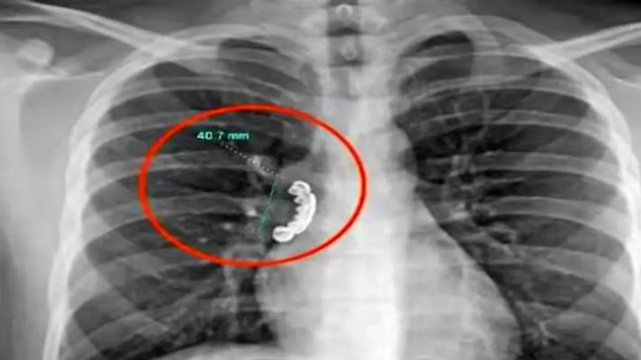 denture stuck in lung denture stuck in lung