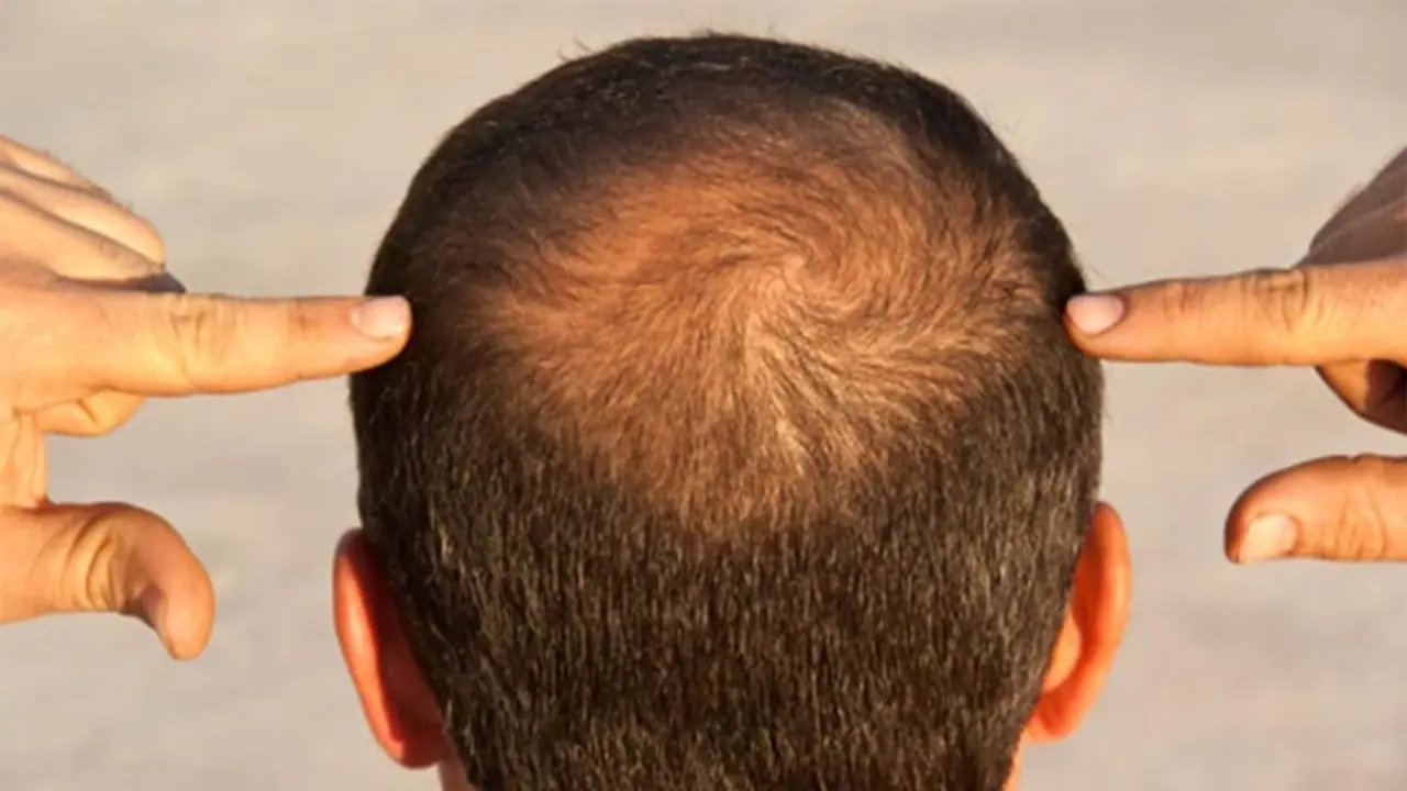 Hair loss myth vs reality Hair loss myth vs reality