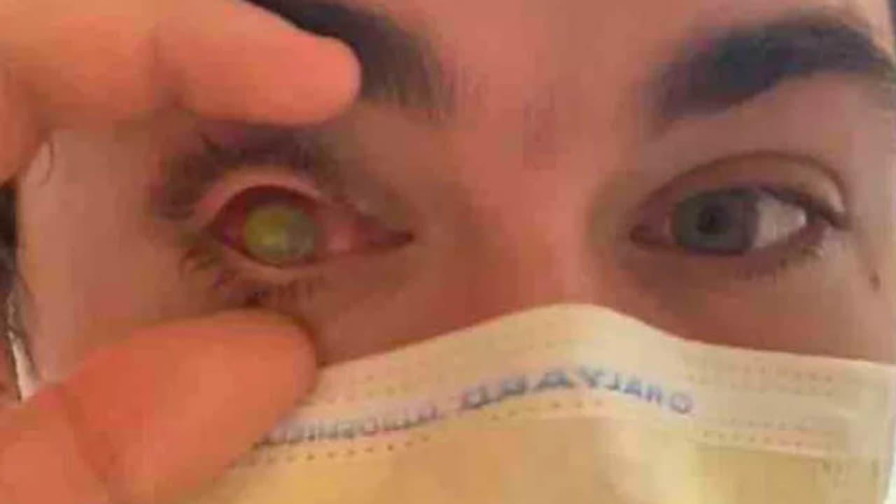 parasite ate eye parasite ate eye