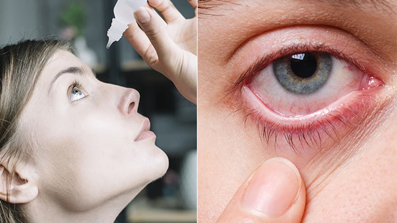 Conjunctivitis Symptoms Conjunctivitis Symptoms