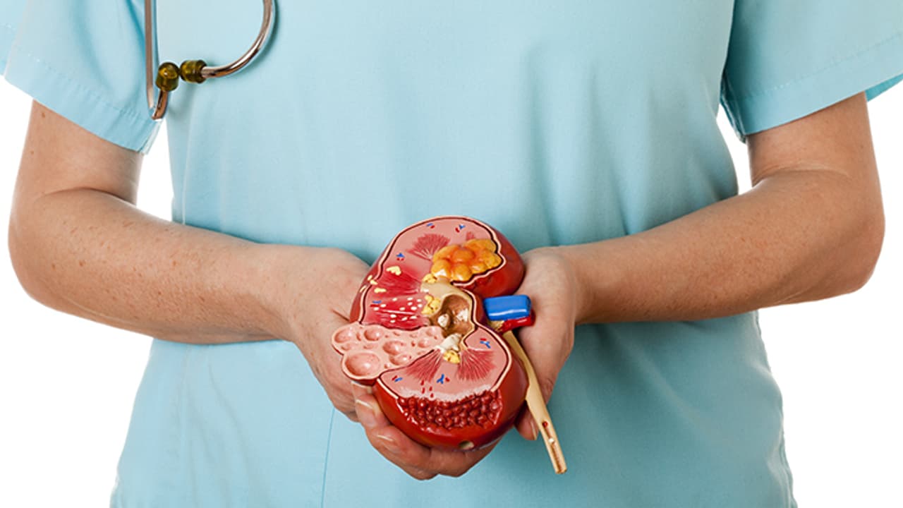 kidney stone kidney stone