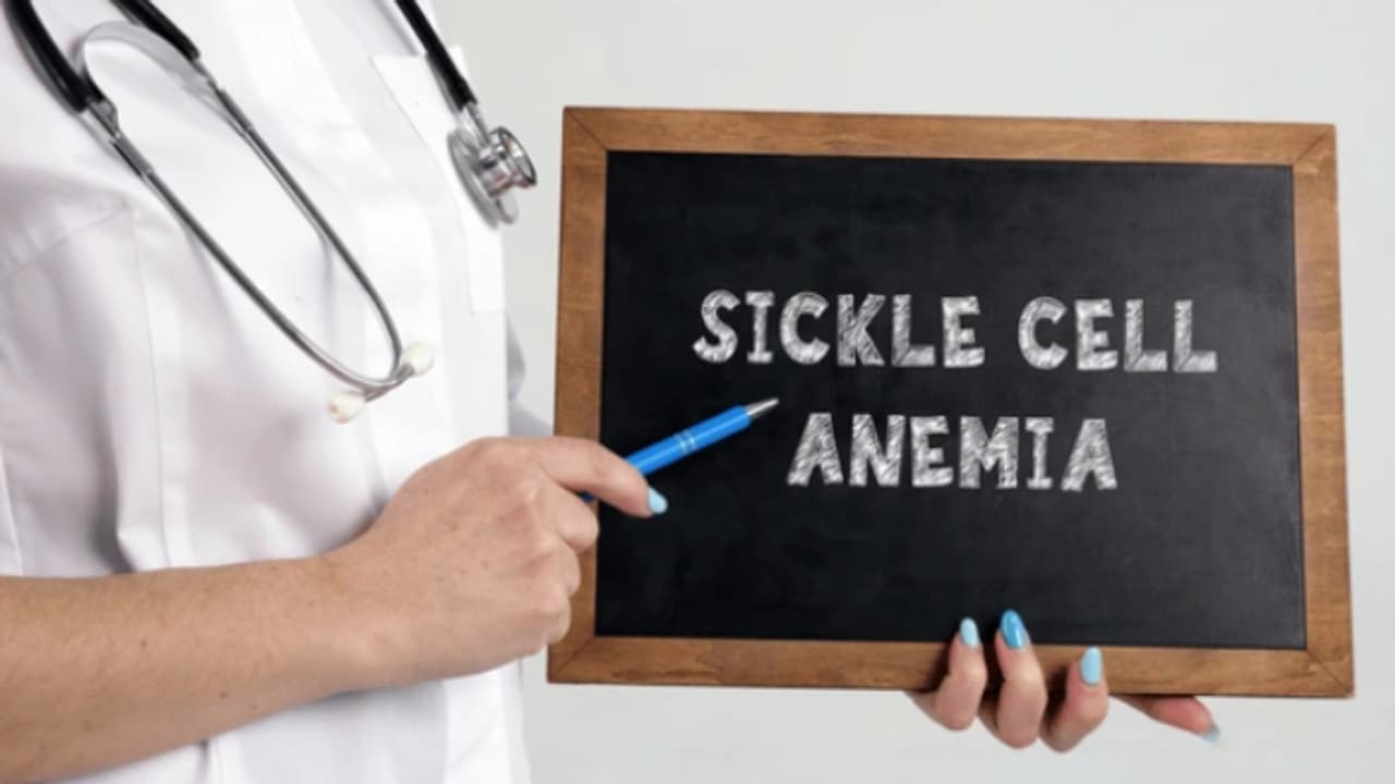 Sickle cell anemia 1 Sickle cell anemia 1