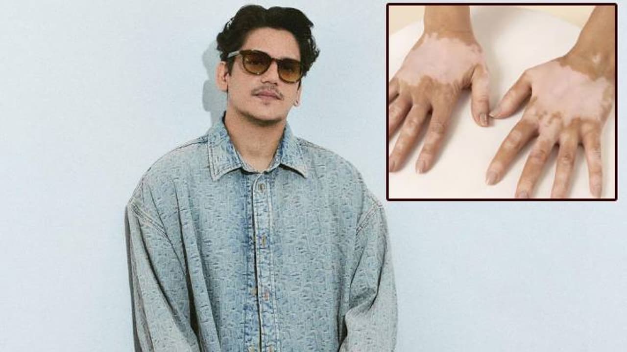  Vitiligo condition know about myth and fact 