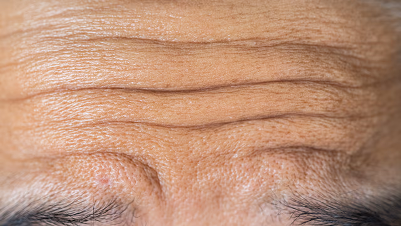 forhead lines 01 forhead lines 01