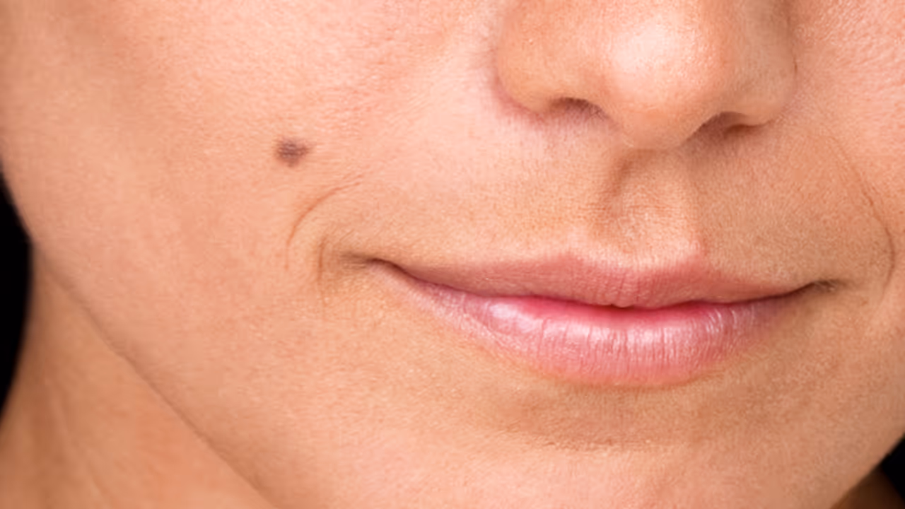 palmistry mole on face palmistry mole on face