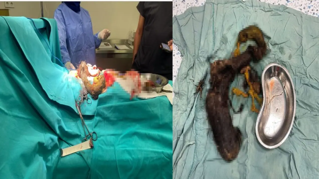 Hair found in Ajmer girl's stomach Hair found in Ajmer girl's stomach