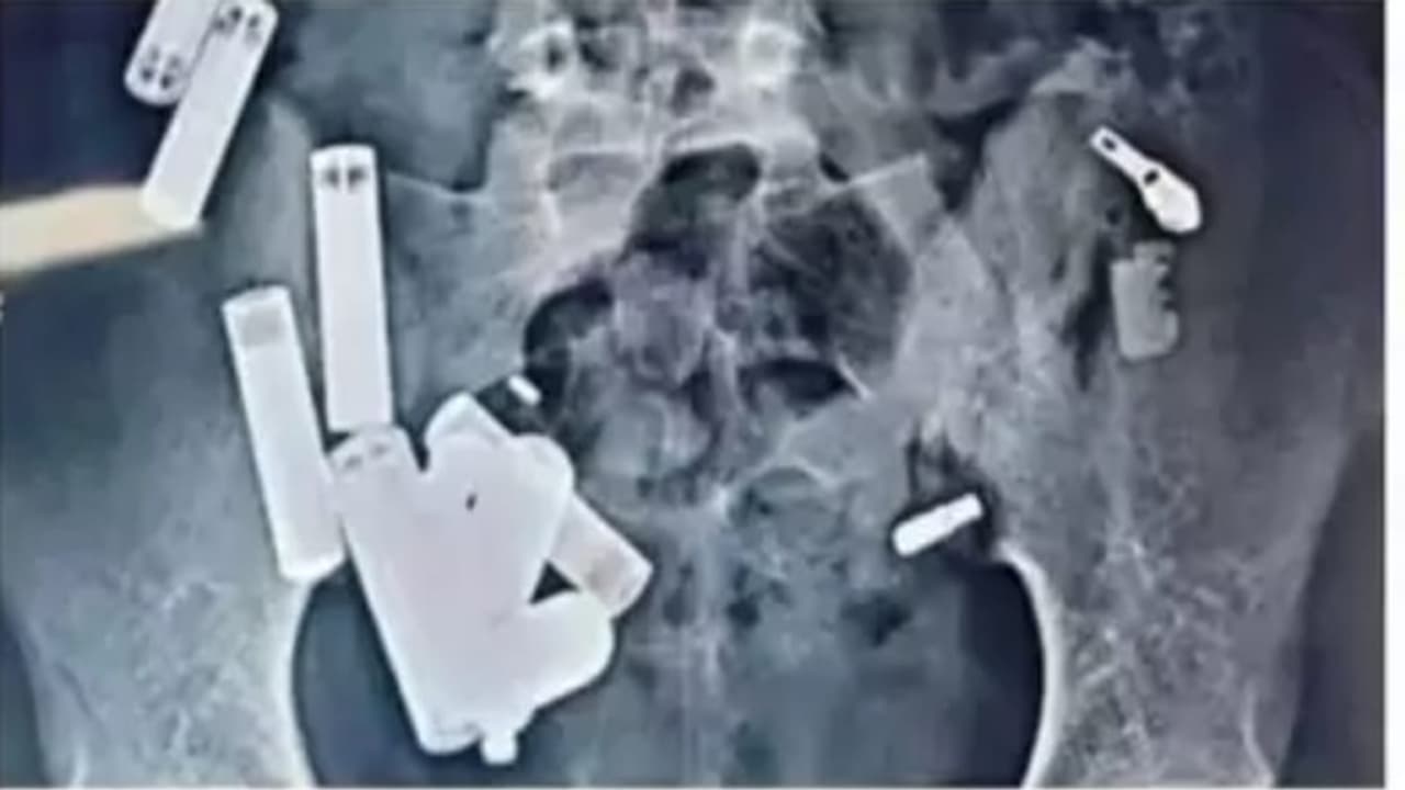 Ultrasound report of Hathras teenager Ultrasound report of Hathras teenager