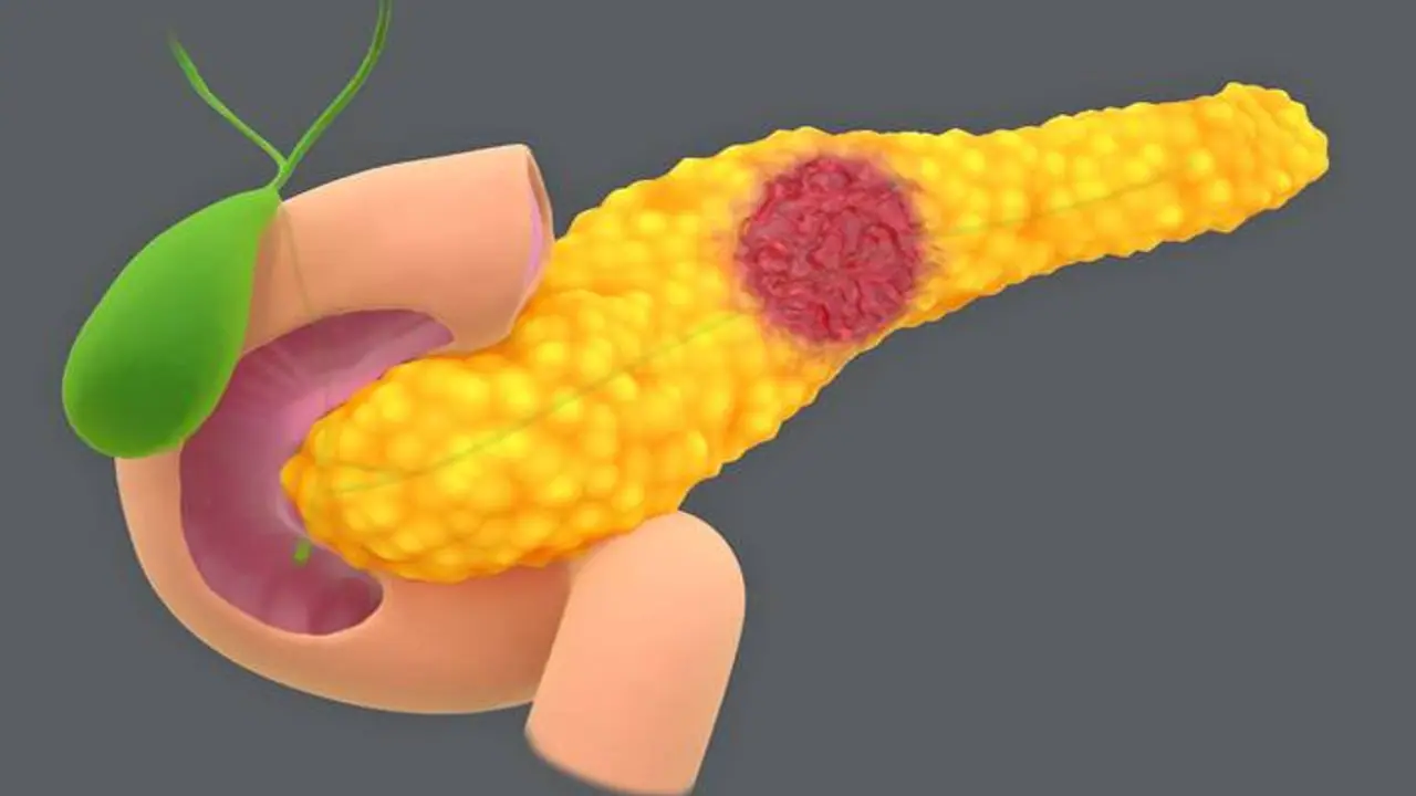 Bile Duct Cancer Bile Duct Cancer