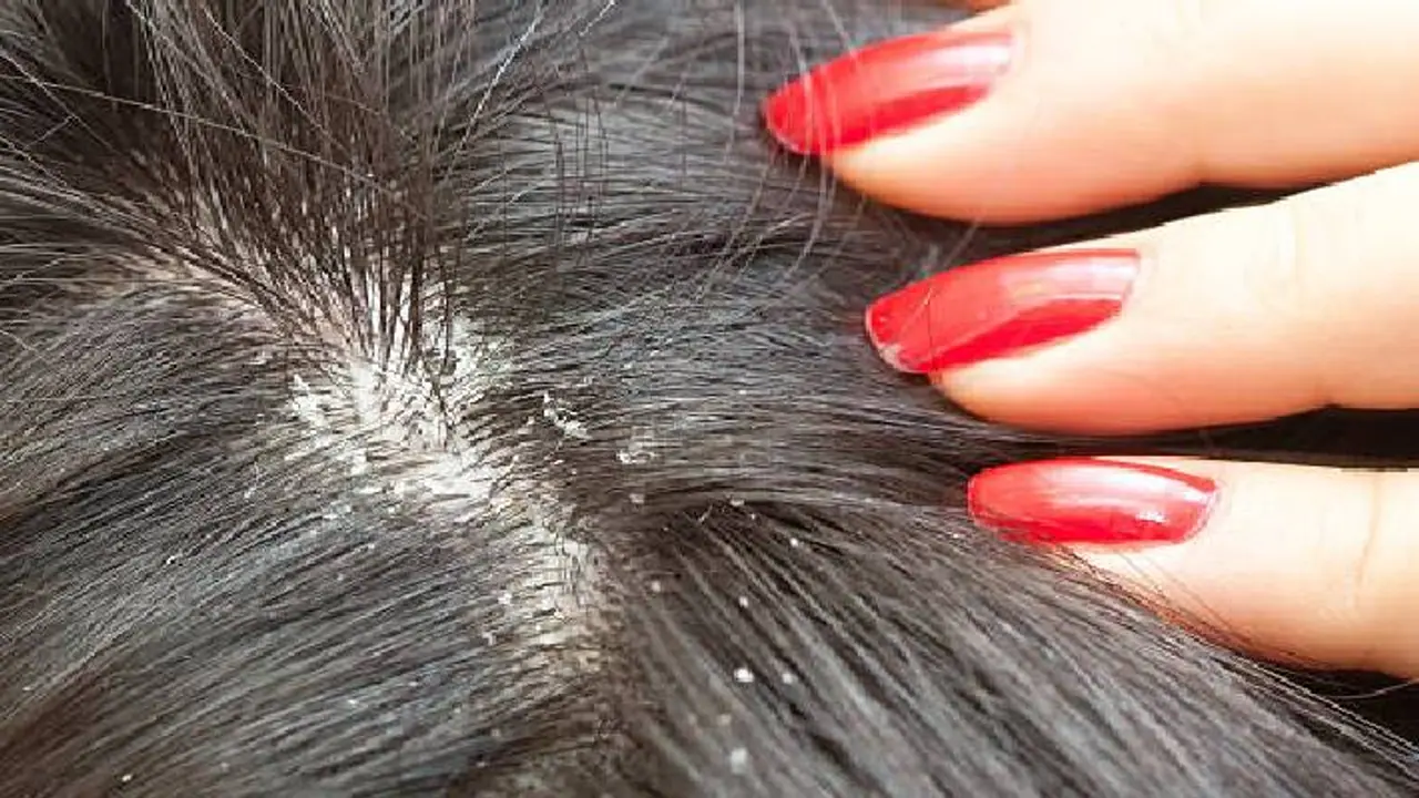 Dandruff Dandruff