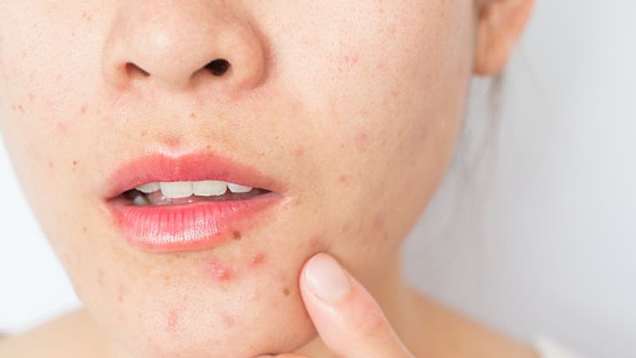 causes of teenage acne