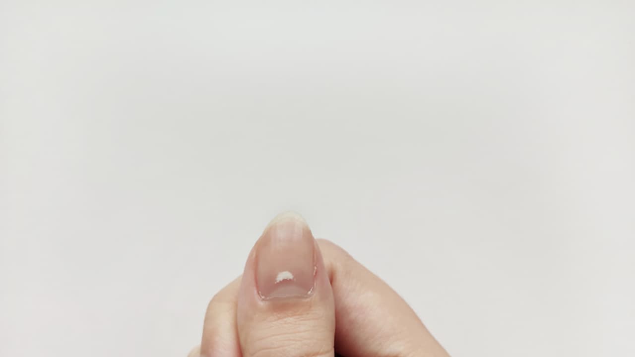 White marks on Nails White marks on Nails