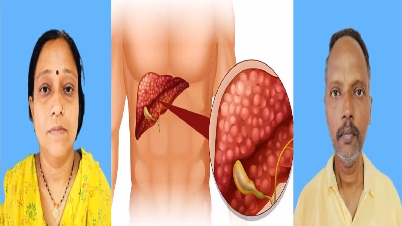 Wife Donates Liver Husband Dies