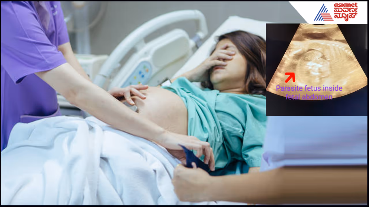 Foetus inside foetus