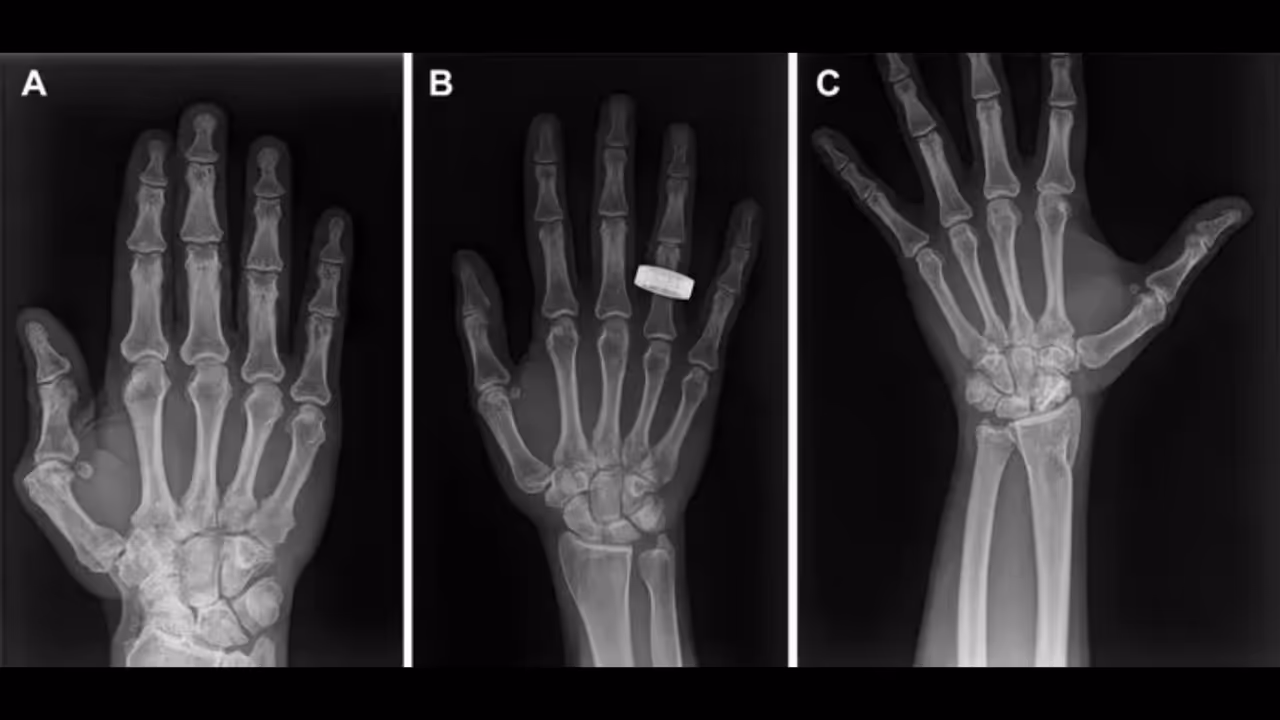 1st ever X rays in space, 1st ever X rays in space,