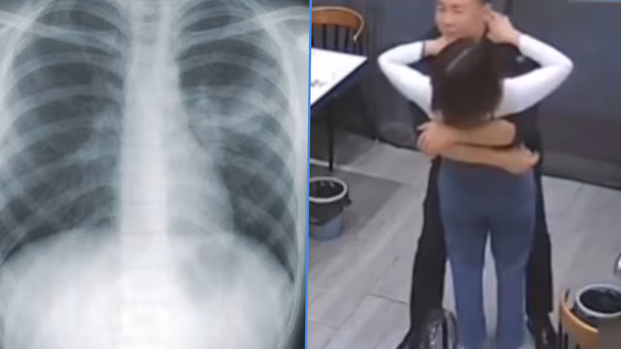 Chinese Woman Suffers Five Broken Ribs After Husband Hugs Her Tight Chinese Woman Suffers Five Broken Ribs After Husband Hugs Her Tight