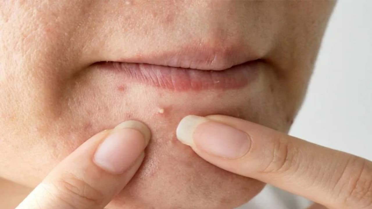how to prevent acne breakouts before periods 