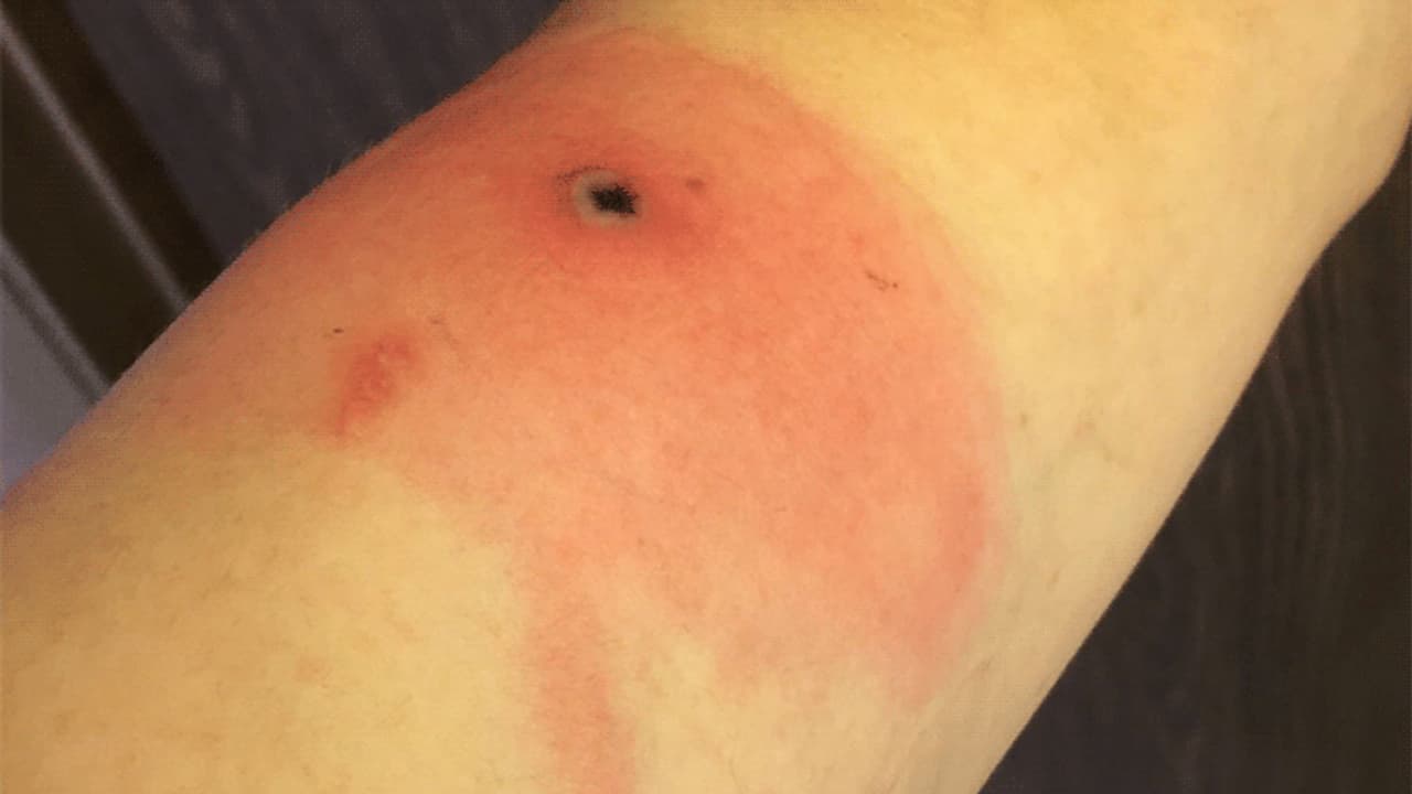 Alaskapox Virus Alaskapox Virus