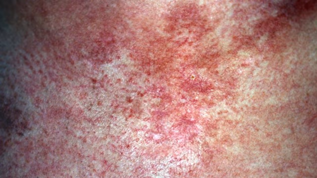 cancer symptoms, cancer diagnosis, scotland, scotland latest news, latest news, viral news, shocking news, trending news cancer symptoms, cancer diagnosis, scotland, scotland latest news, latest news, viral news, shocking news, trending news