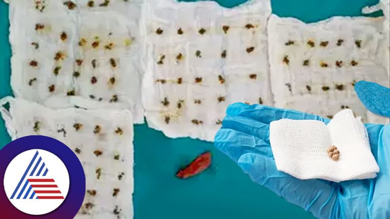 Health Doctor who removed 1000 gallstones in 20 minutes Health Doctor who removed 1000 gallstones in 20 minutes